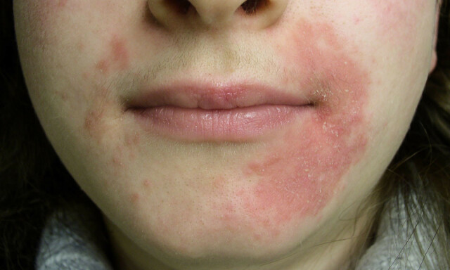 image: Perioral dermatitt: Utslett rundt munn og hake
